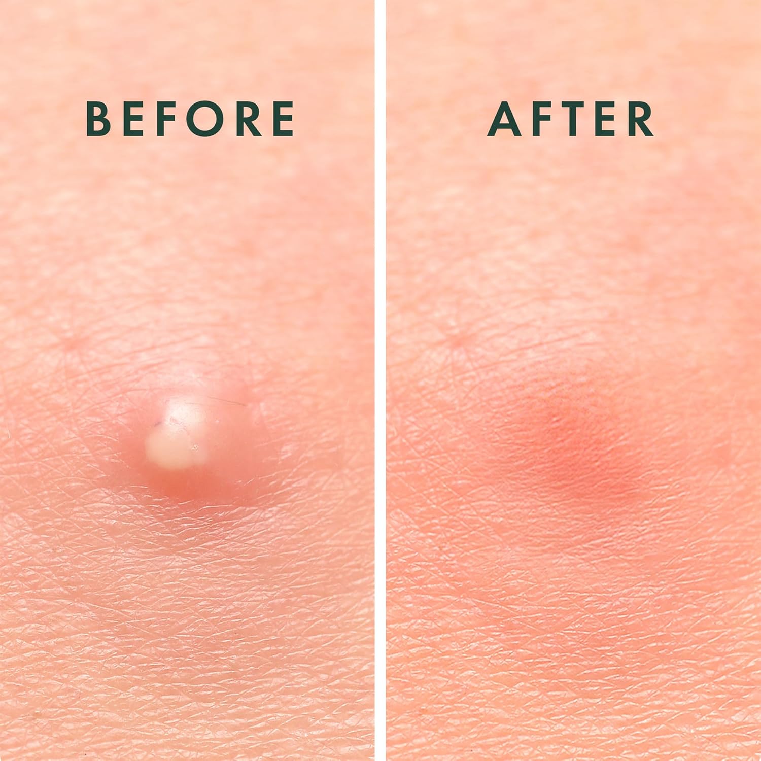 Rael Pimple Patches, Miracle Invisible Spot Cover - Hydrocolloid Acne Patch, Treatment for Breakouts, Absorbs Zits & Blemish, Korean Skin Care, 2 Sizes (96 Count)